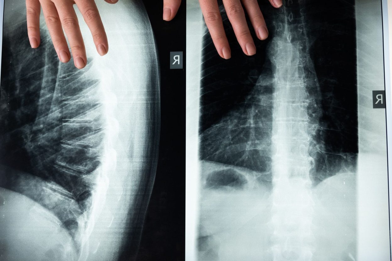 Des cellules souches de tendons et ligaments observées dans le cadre des travaux sur la sténose lombaire